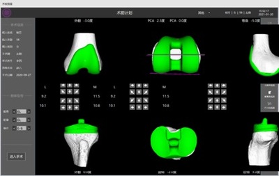 膝关节置换手术导航系统3.jpg