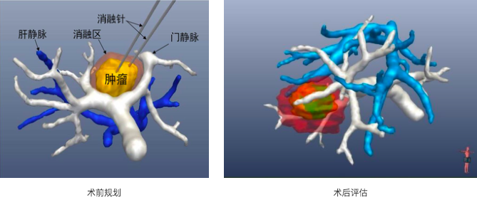 术前规划和术后评估.png